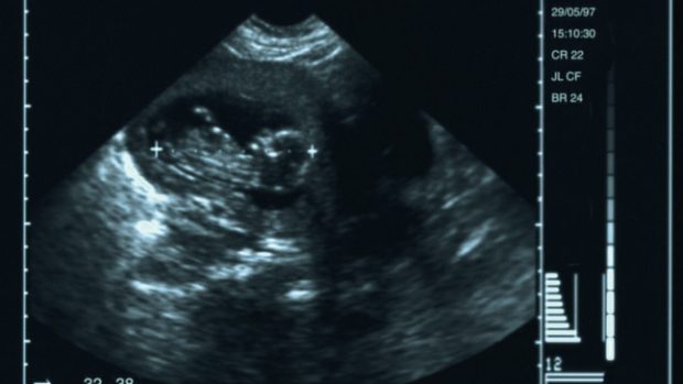 Embryo na ultrazvukovém snímku