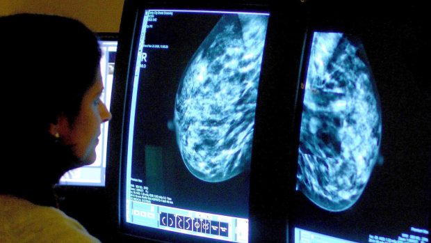 Výsledky z mamografie. Ilustrační foto