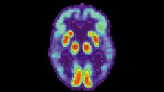 Mozek pacienta trpícího Alzheimerovou chorobou - snímek pořízený pozitronovou emisní tomografií (PET)