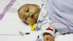 Lékaři v pražském IKEMu transplantovali malému pacientovi část jater od jeho otce