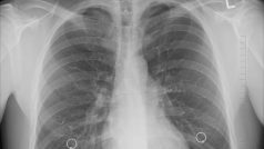 Plíce, zápal plic, rentgen (ilustrační foto)