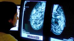 Výsledky z mamografie. Ilustrační foto