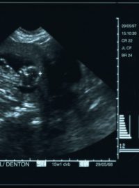 Embryo na ultrazvukovém snímku