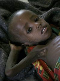 Dítě trpící podvýživou je léčeno na pediatrickém oddělení zdravotnického střediska Lékařů bez hranic v Hudduru. Podvýživa je endemická na mnoha místech v Somálsku.