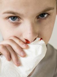 Krvácení z nosu (ilustrační foto)