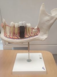 Malý kovový váleček je v podstatě umělý zubní kořen