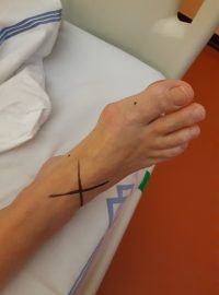 Operace vbočeného palce